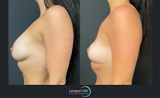 Breast Explant Before & After Gallery - Patient 122908906 - Image 3