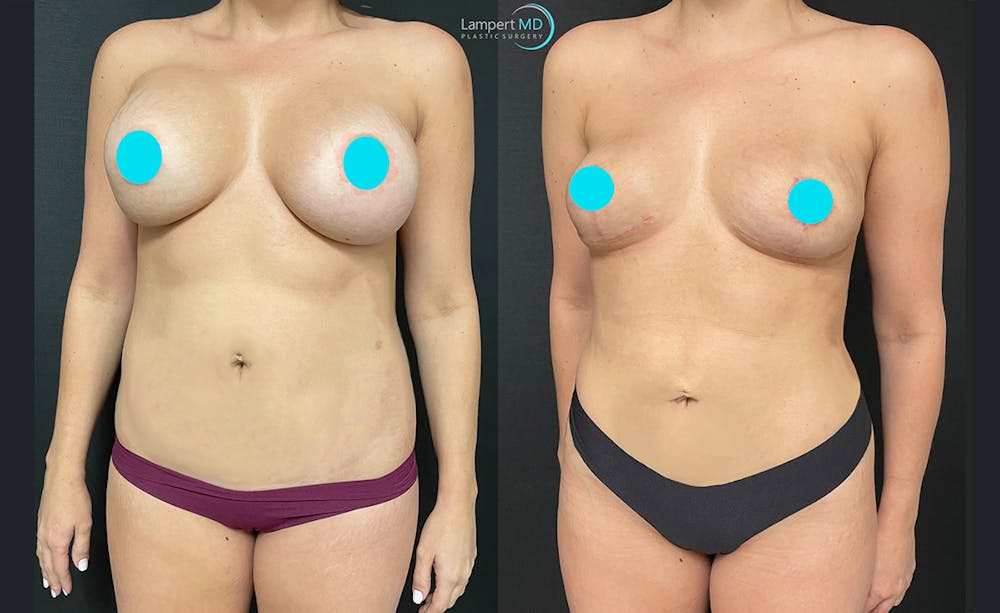 Breast Explant Before & After Gallery - Patient 122908911 - Image 2