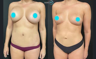 Breast Explant Before & After Gallery - Patient 122908911 - Image 2