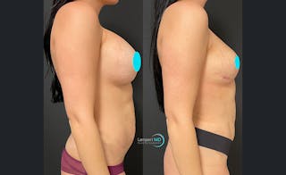 Breast Explant Before & After Gallery - Patient 122908911 - Image 3