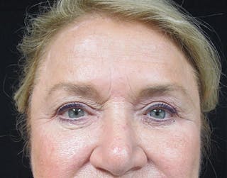 Brow Lift Before & After Gallery - Patient 122908940 - Image 2