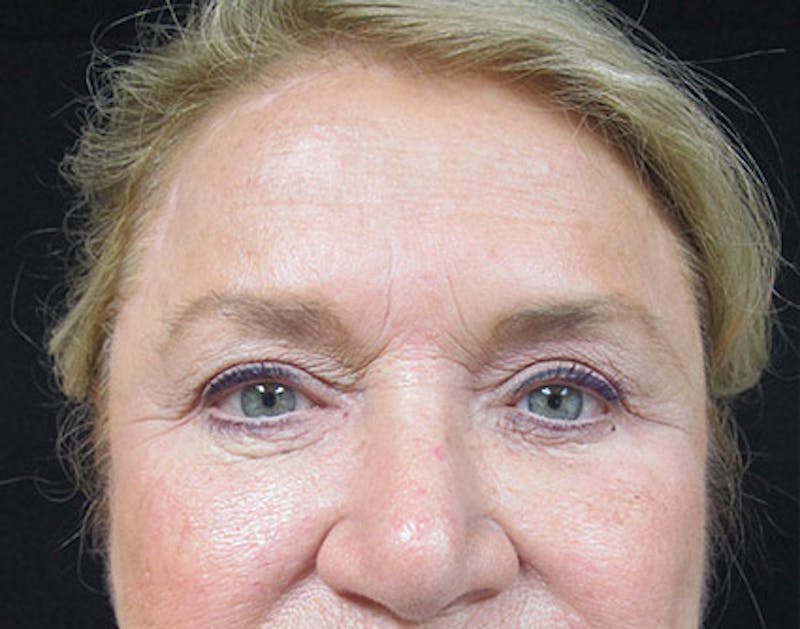 Brow Lift Before & After Gallery - Patient 122908940 - Image 2