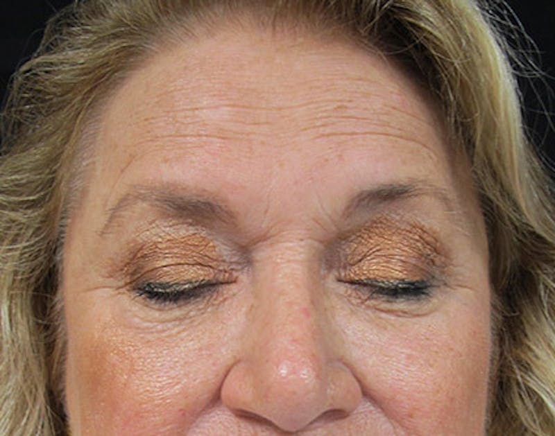 Brow Lift Before & After Gallery - Patient 122908940 - Image 3
