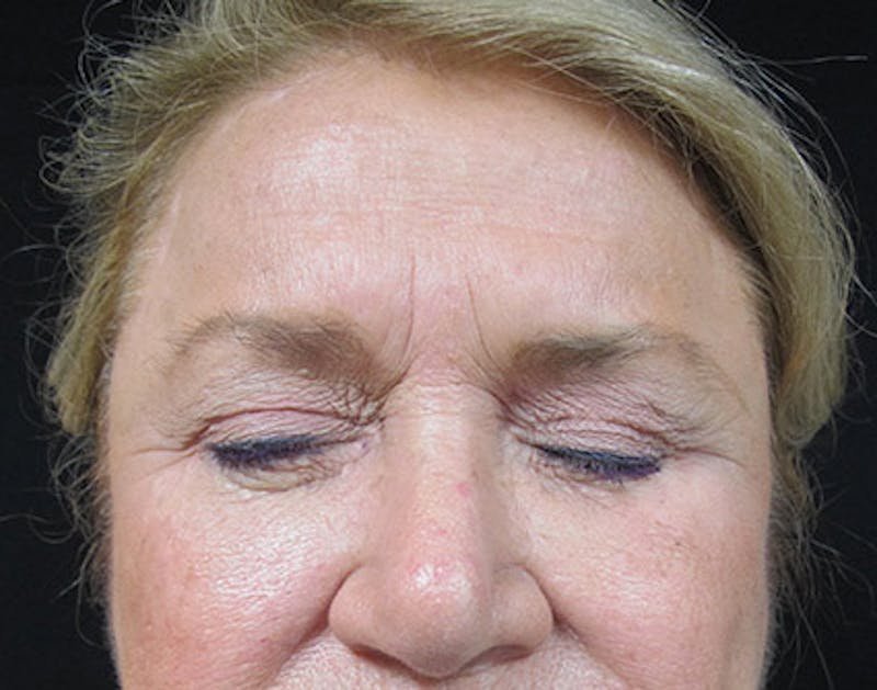 Brow Lift Before & After Gallery - Patient 122908940 - Image 4
