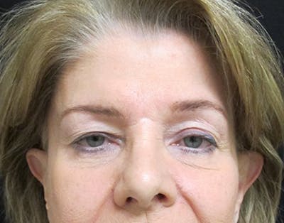 Brow Lift Before & After Gallery - Patient 122908941 - Image 1