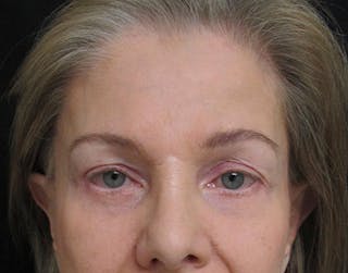 Brow Lift Before & After Gallery - Patient 122908941 - Image 2