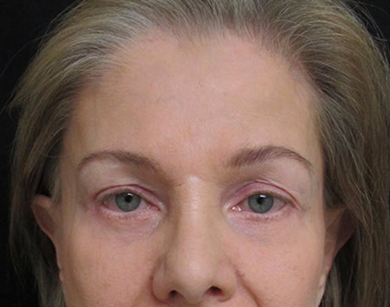 Brow Lift Before & After Gallery - Patient 122908941 - Image 2