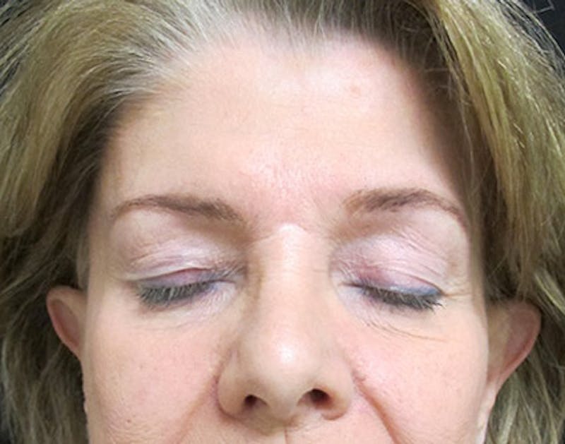 Brow Lift Before & After Gallery - Patient 122908941 - Image 3