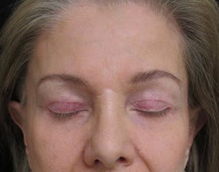 Brow Lift Before & After Gallery - Patient 122908941 - Image 4