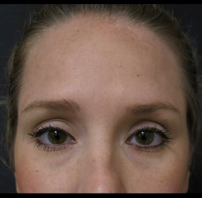 Eyelid Surgery Before & After Gallery - Patient 122908955 - Image 1