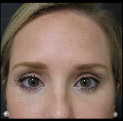 Eyelid Surgery Before & After Gallery - Patient 122908955 - Image 2