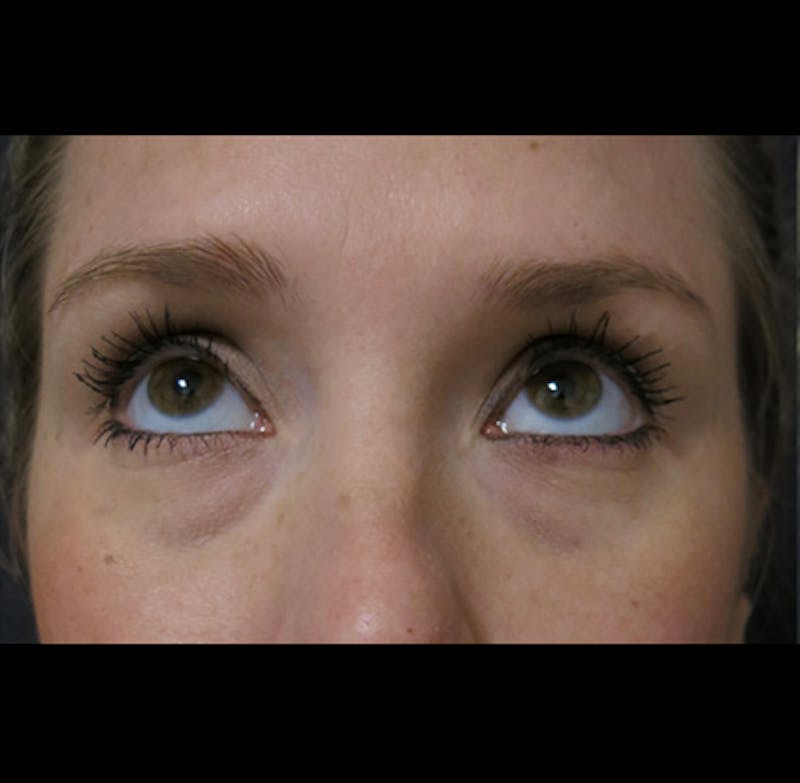 Eyelid Surgery Before & After Gallery - Patient 122908955 - Image 3
