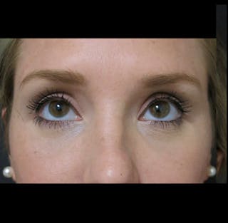 Eyelid Surgery Before & After Gallery - Patient 122908955 - Image 4