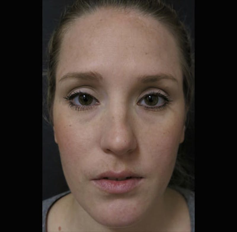 Eyelid Surgery Before & After Gallery - Patient 122908955 - Image 5