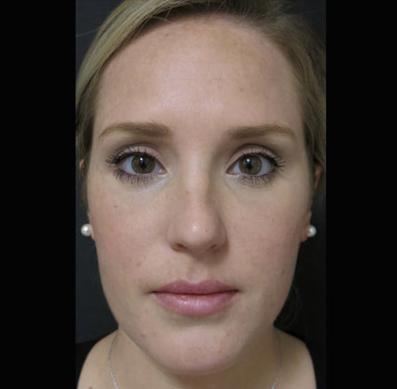 Eyelid Surgery Before & After Gallery - Patient 122908955 - Image 6