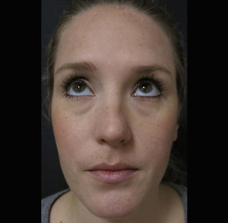 Eyelid Surgery Before & After Gallery - Patient 122908955 - Image 7