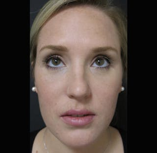Eyelid Surgery Before & After Gallery - Patient 122908955 - Image 8