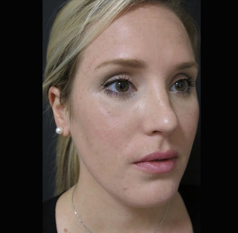 Eyelid Surgery Before & After Gallery - Patient 122908955 - Image 10