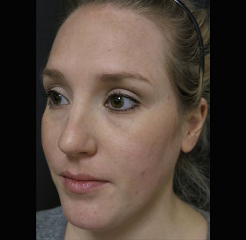 Eyelid Surgery Before & After Gallery - Patient 122908955 - Image 11