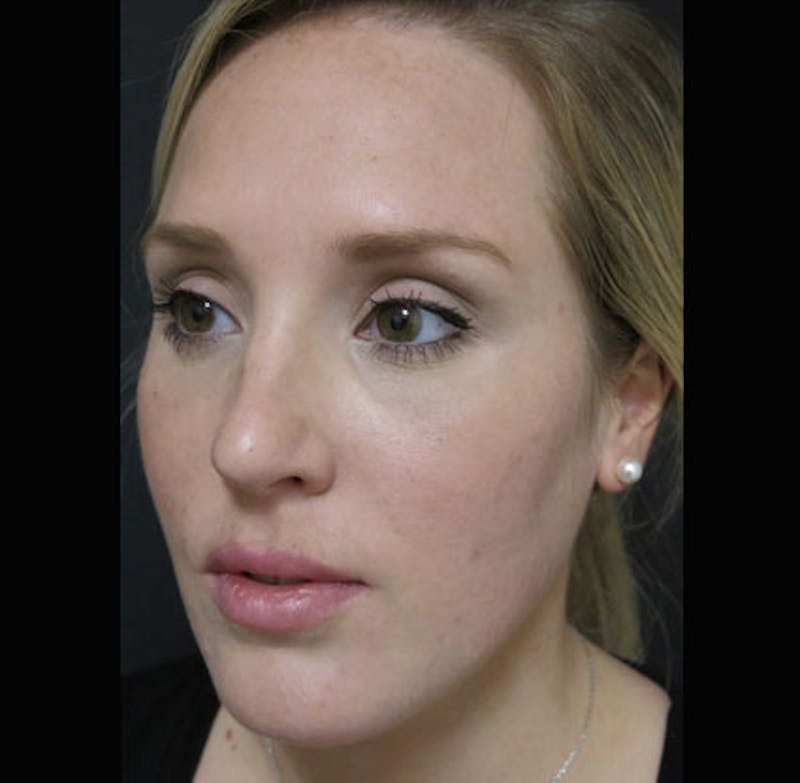 Eyelid Surgery Before & After Gallery - Patient 122908955 - Image 12