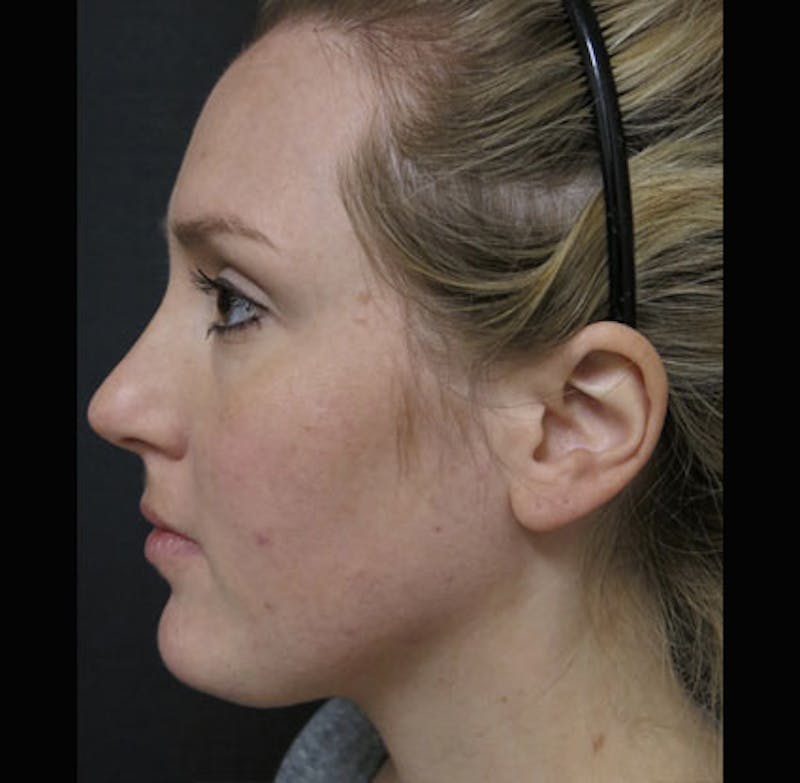 Eyelid Surgery Before & After Gallery - Patient 122908955 - Image 13
