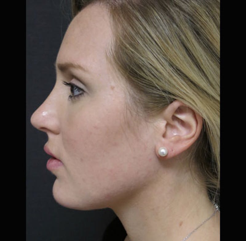 Eyelid Surgery Before & After Gallery - Patient 122908955 - Image 14