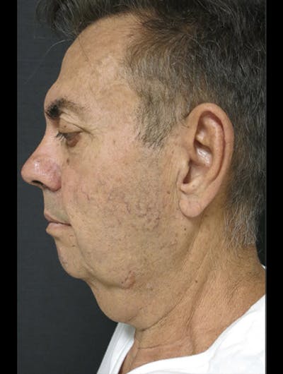Face & Neck Lift Before & After Gallery - Patient 122908962 - Image 1