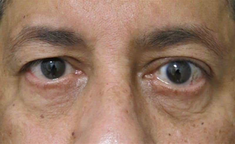 Eyelid Surgery Before & After Gallery - Patient 122908957 - Image 1