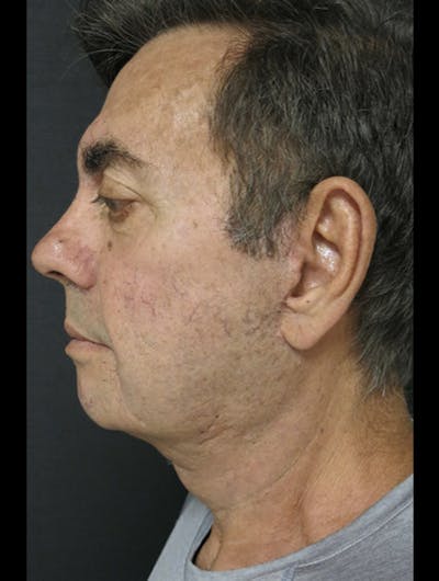 Face & Neck Lift Before & After Gallery - Patient 122908962 - Image 2