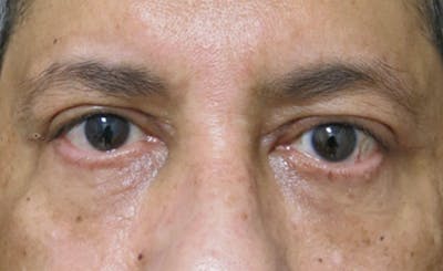 Eyelid Surgery Before & After Gallery - Patient 122908957 - Image 2