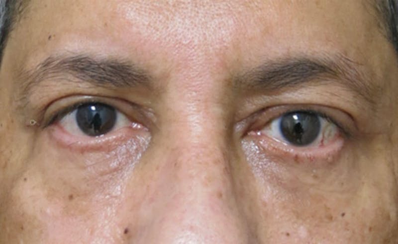 Eyelid Surgery Before & After Gallery - Patient 122908957 - Image 2