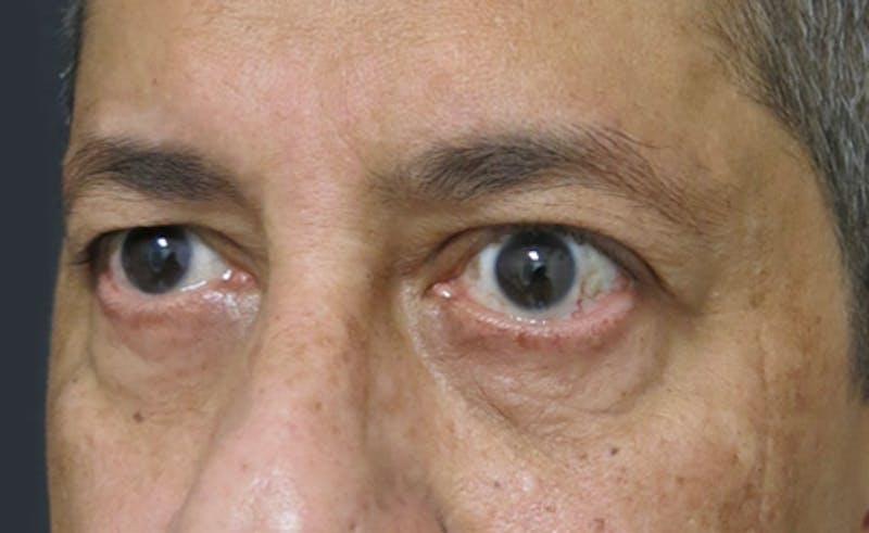 Eyelid Surgery Before & After Gallery - Patient 122908957 - Image 3