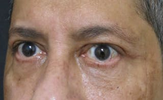 Eyelid Surgery Before & After Gallery - Patient 122908957 - Image 4