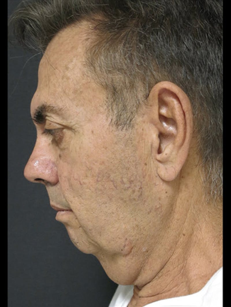 Face & Neck Lift Before & After Gallery - Patient 122908962 - Image 5