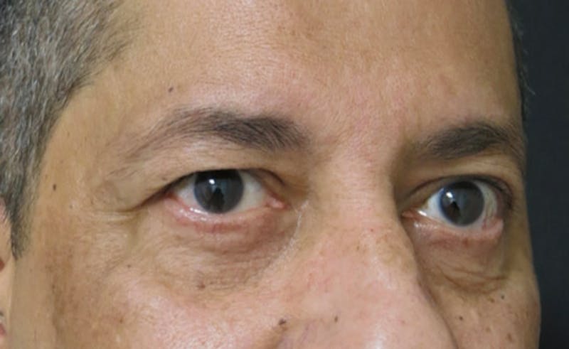 Eyelid Surgery Before & After Gallery - Patient 122908957 - Image 5