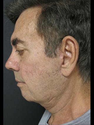 Face & Neck Lift Before & After Gallery - Patient 122908962 - Image 6