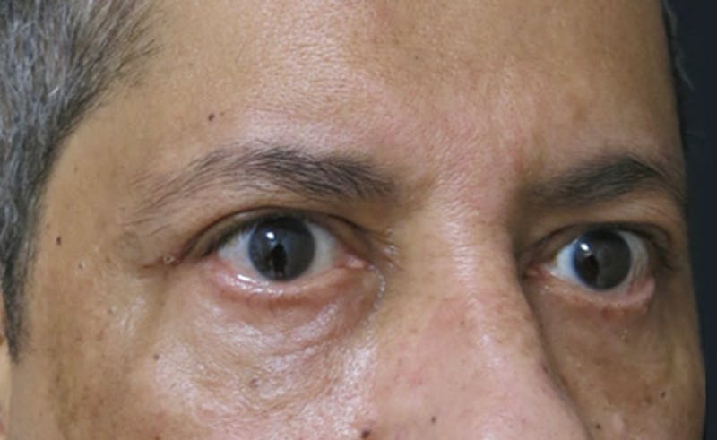 Eyelid Surgery Before & After Gallery - Patient 122908957 - Image 6
