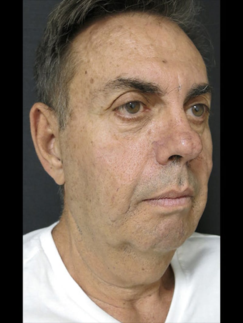 Face & Neck Lift Before & After Gallery - Patient 122908962 - Image 7