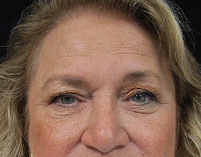 Eyelid Surgery Before & After Gallery - Patient 122908958 - Image 1