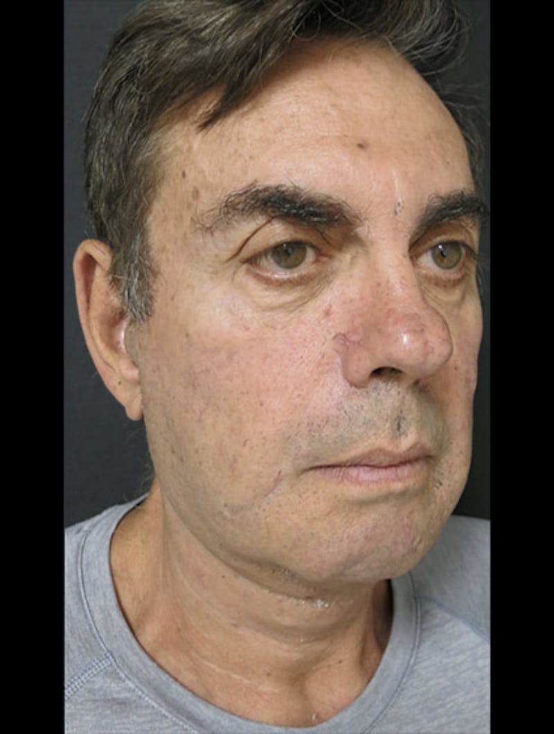 Face & Neck Lift Before & After Gallery - Patient 122908962 - Image 8