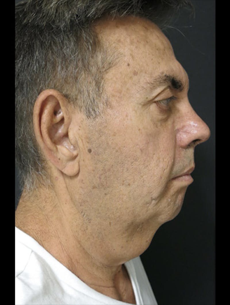 Face & Neck Lift Before & After Gallery - Patient 122908962 - Image 9