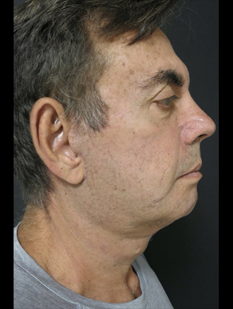 Face & Neck Lift Before & After Gallery - Patient 122908962 - Image 10
