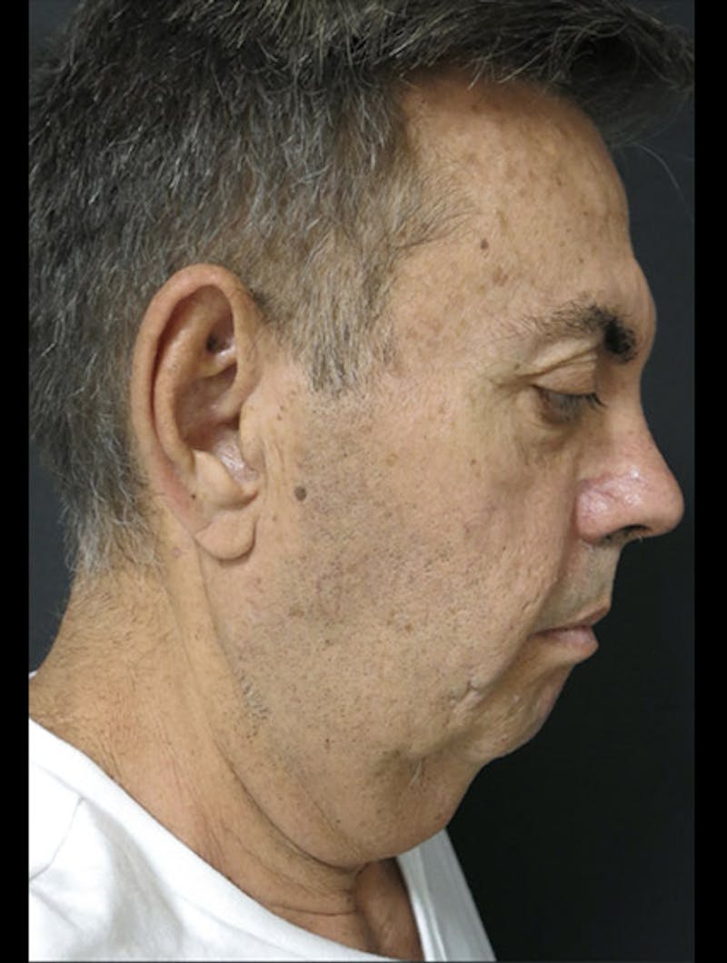 Face & Neck Lift Before & After Gallery - Patient 122908962 - Image 11