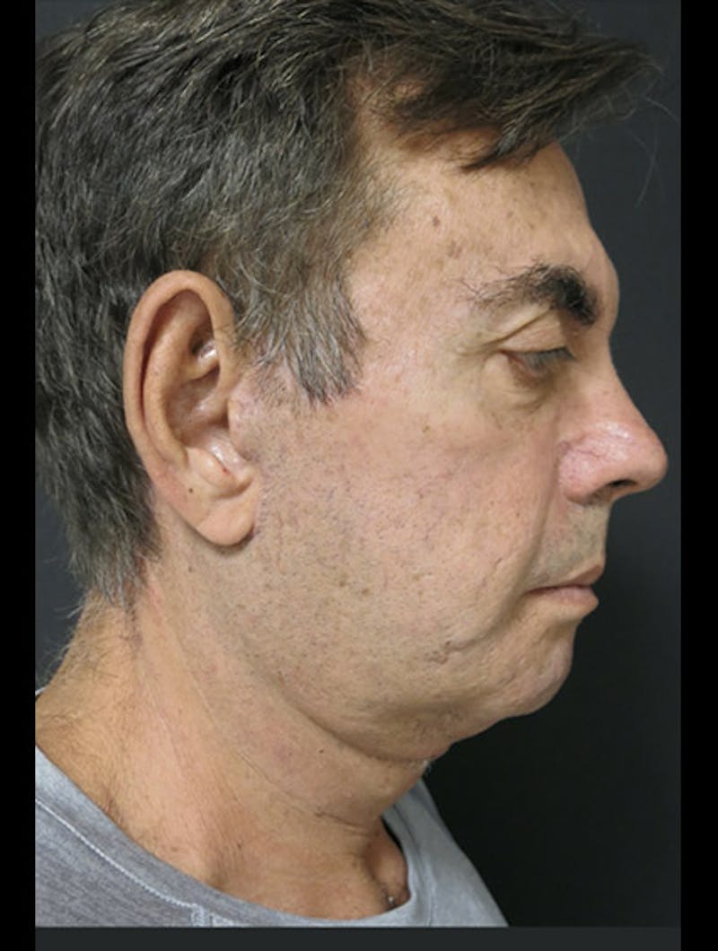 Face & Neck Lift Before & After Gallery - Patient 122908962 - Image 12