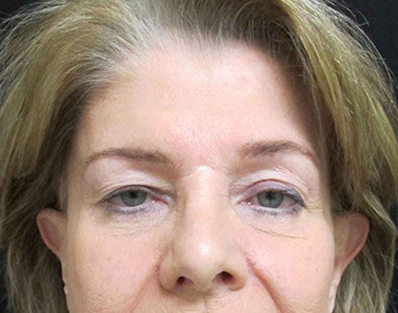 Eyelid Surgery Before & After Gallery - Patient 122908961 - Image 1