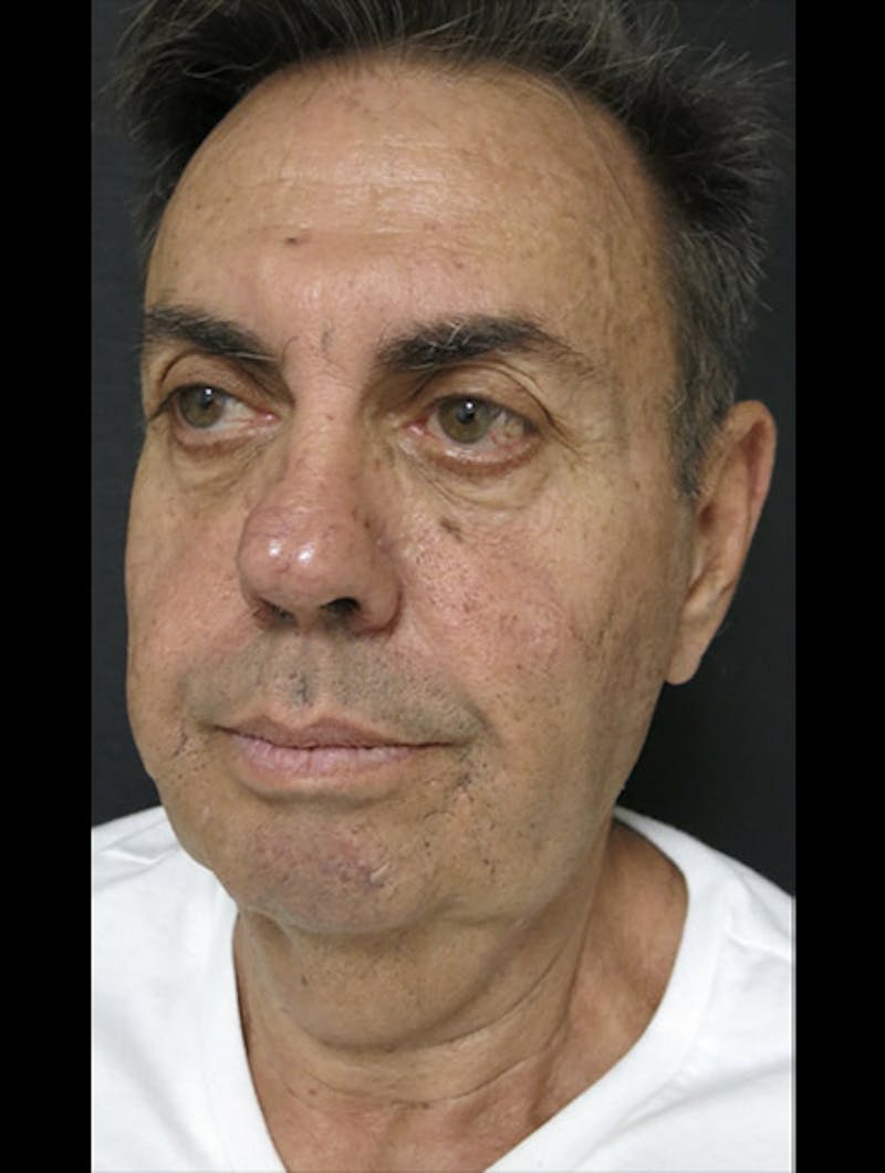 Face & Neck Lift Before & After Gallery - Patient 122908962 - Image 13