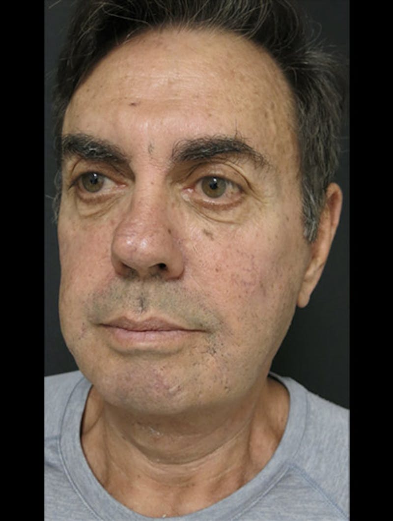 Face & Neck Lift Before & After Gallery - Patient 122908962 - Image 14