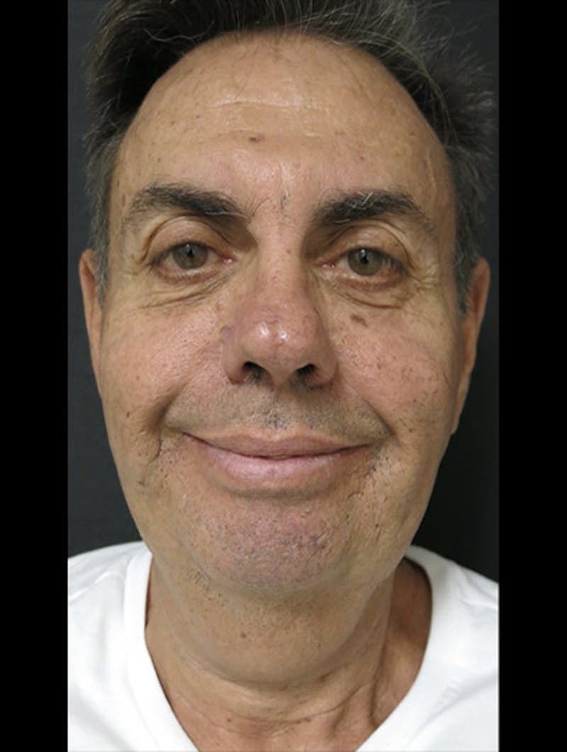 Face & Neck Lift Before & After Gallery - Patient 122908962 - Image 15