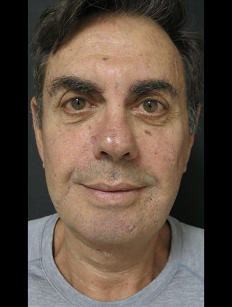 Face & Neck Lift Before & After Gallery - Patient 122908962 - Image 16