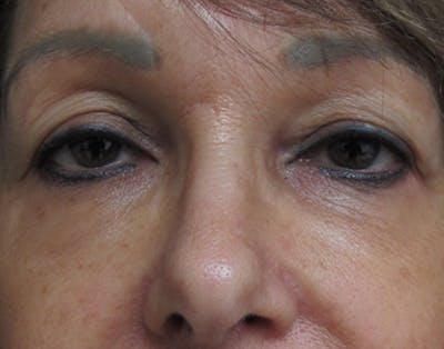 Eyelid Surgery Before & After Gallery - Patient 122908963 - Image 1